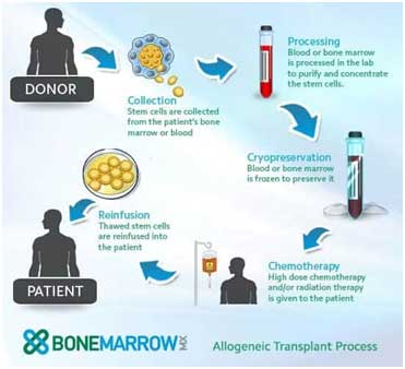 Allogeneic Transplant Process