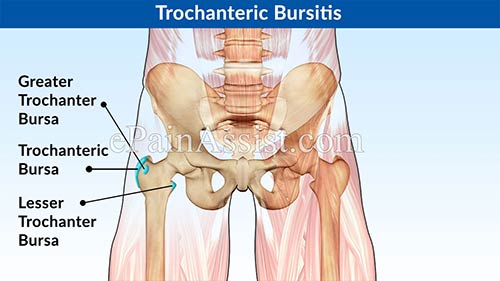 https://www.somaorthopedics.com/images/Trochanteric-Bursitis-med.jpg