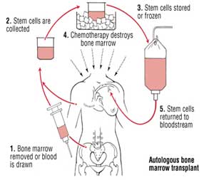 Autologous bone marrow transplant