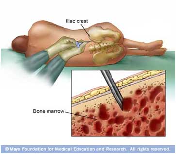 Bone Marrow Replacement