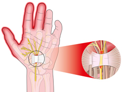 Ulnar Nerve Entrapment at the Elbow (Cubital Tunnel Syndrome