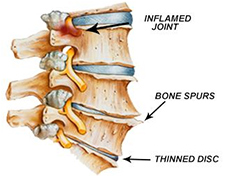 Inflamed Joint, Bone Spurs, Thinned Disc
