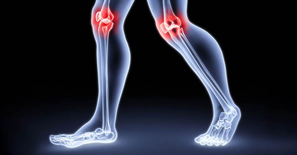 X-Ray Showing Pain in the Knees