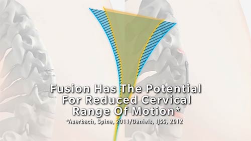 Fusion has the potential for reduced cervical range of motion