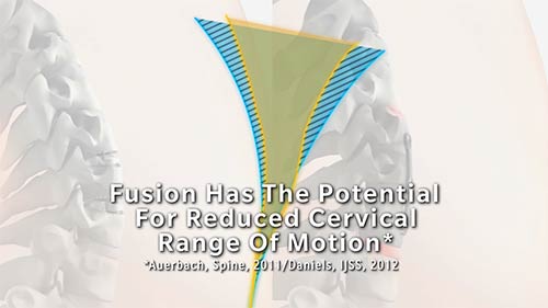 Fusion has the potential for reduced cervical range of motion