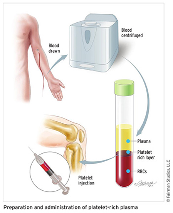 Preparation and administration of platelet-rich plasma